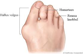 voet-reuma[1].png